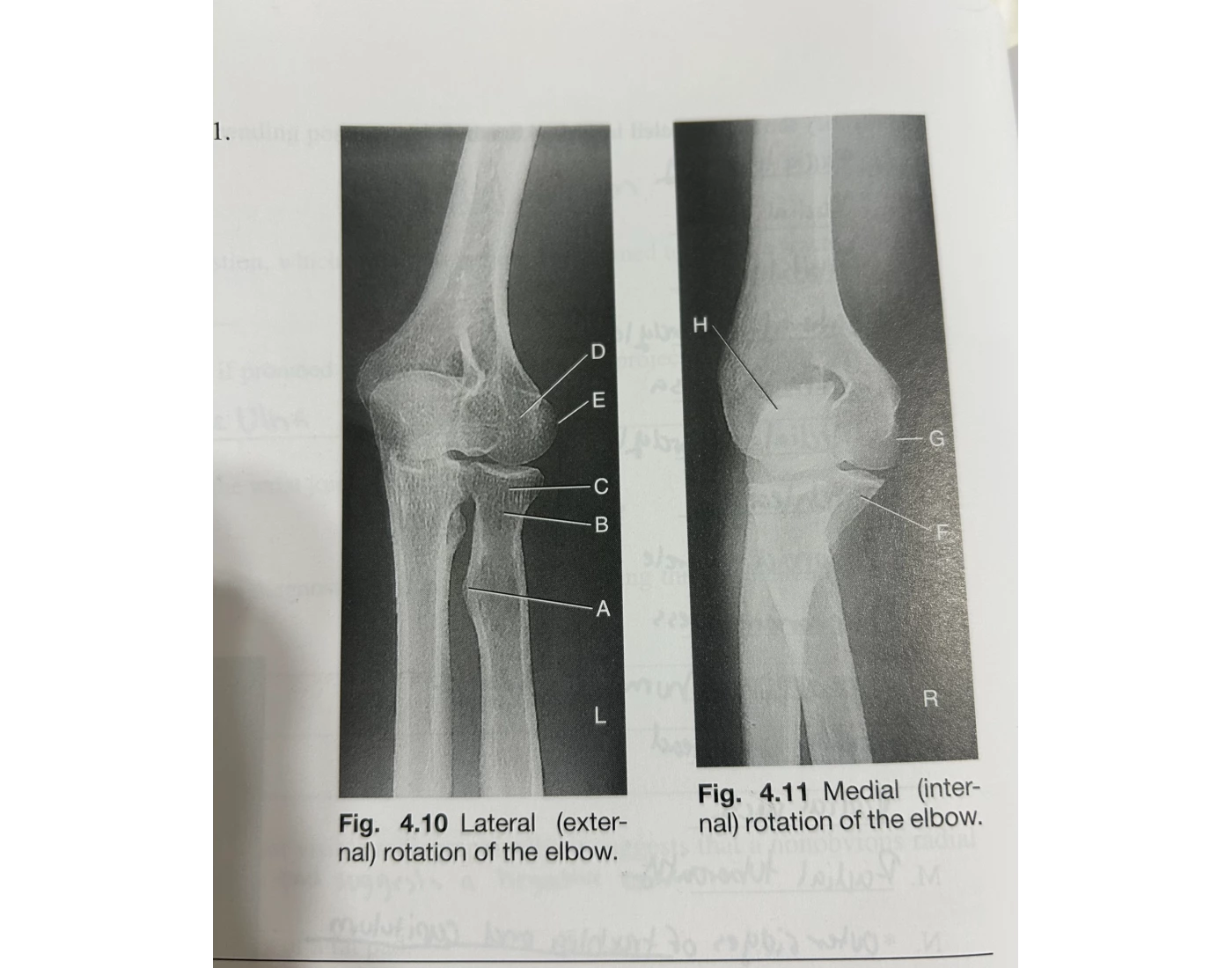 Lateral Rotation Elbow Positioning Lateral And Medial Rotation of The Elbow Quiz