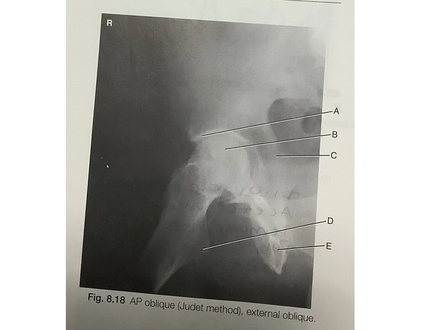 Judet Method Radiography AP Oblique Judet Method External Rotation Quiz