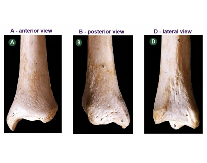 Distal Tibia Landmarks Distal end of tibia - Bony landmarks — Printable Worksheet